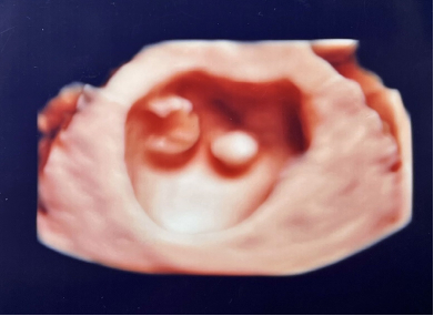 4D胎児エコー写真（6週）