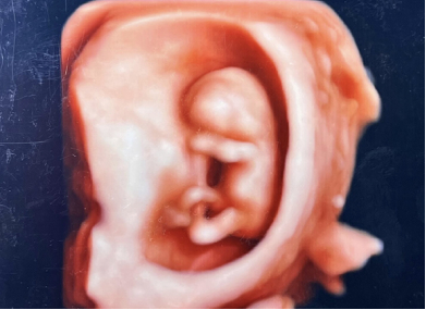 4D胎児エコー写真（10週）