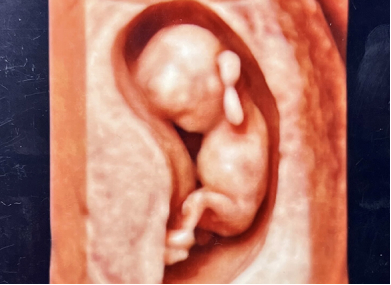 4D胎児エコー写真（12週）