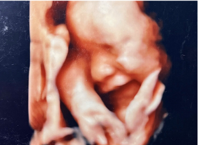 4D胎児エコー写真（30週）